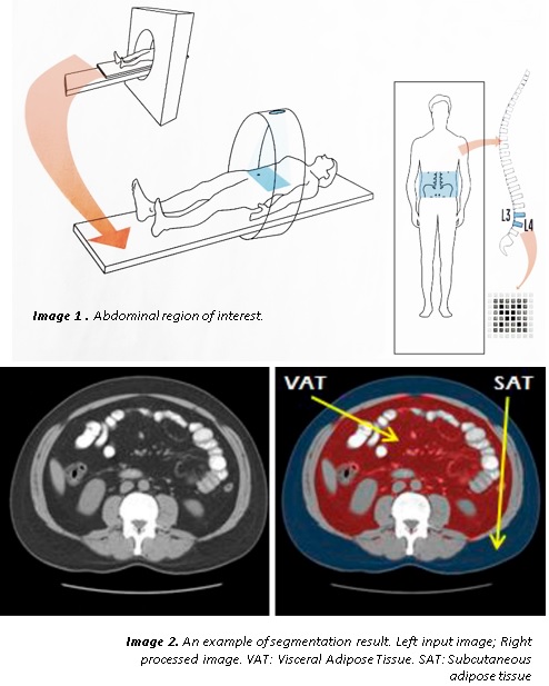 CAAVAT - Computer Assisted Analysis of Visceral Adipose Tissue (VAT) on CT Images